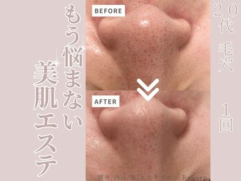 リボーン(Reborn)/20代　毛穴(1回)