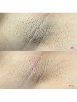 フェイシャルクレア(Cre A.)/脇脱毛1回での変化