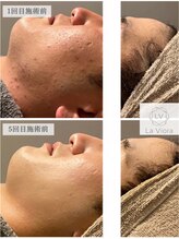 ラヴィオーラ 西大寺(La Viora) ハーブ ピーリング