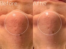 マイナプラ 表参道(myna+)の雰囲気（【プレミアム毛穴洗浄】特殊な角栓除去剤で毛穴汚れを吸引！）