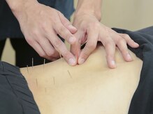 白雲堂鍼灸整骨院/鍼でこりをほぐし血流改善