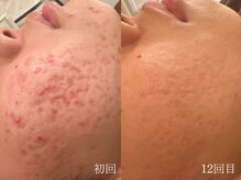 ウォーム(warm)/ニキビケア/肌荒れ/ニキビ肌