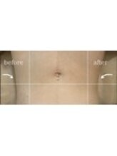リフト 門前仲町(Lift)/小顔専門店Lift|Before After