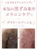 ☆まずはカウンセリング☆本気の黒ずみ集中メラニンケア☆デリケートゾーンも
