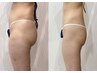 【蓄積した凸凹セルライトを集中ケア】なめらかで引き締まった美ボディへ60分
