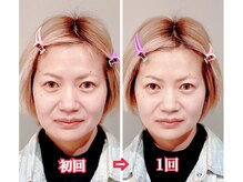 小顔22 ボルティ 赤坂支店(Bolty)/小顔シンメトリー矯正【1回】