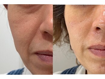 シャンディ(Shandy)/松ヤニエステ+エクソソーム導入