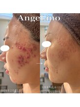 アンジェリーノ(AngeLino)/1回の変化