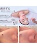 ほうれい線/毛穴/たるみ改善/シフォンピーリングプラス27500円→18000円