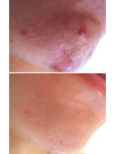 サロンドエステケイワイ(de KY)/フェイシャル☆メンズニキビ改善