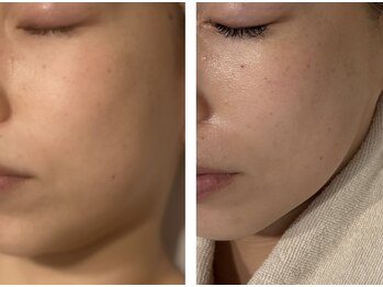 アドビューティ(Add Beauty)/≪たるみ改善／RFリフティング≫