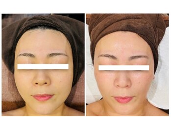 アールユー ギンザ(Ryou ginza)/肌管理トリートメント