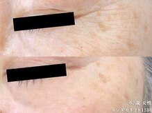 ピュアノア 垂水店/肌質改善フェイシャル　神戸垂水