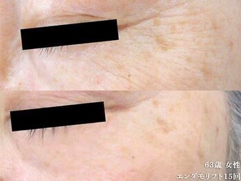 ピュアノア 垂水店/肌質改善フェイシャル　神戸垂水