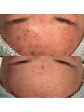 タリア(TALIA)/額の頑固なニキビケアも◎