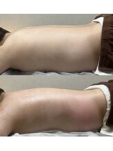 エンルーチェ プラスエイト(en;Luce+8)/上半身・痩身1回の変化