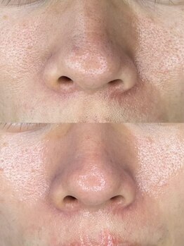 リツイート(ReTweet)/ララピール・艶肌・美白・くすみ