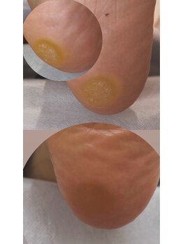 フットミー(foot mii)/厚み1センチ分厚くなったタコ