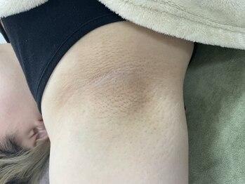 ナノハナ/鹿沼市全身脱毛美容室ナノハナ