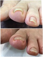 モアクリスタル(More Crystal)/巻き爪補正