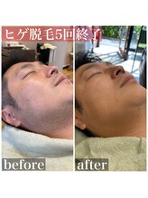 ヘアーズヨシオカ(HAIR'S YOSHIOKA)/#ヒゲ脱毛ビフォーアフター