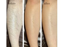 ワイズサロン(Y's salon)/全身脱毛の経過！