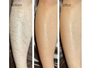 ワイズサロン(Y's salon)/全身脱毛の経過！