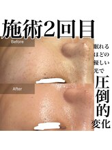 サロンツキ(salon tuki)/【最新光機器】症例