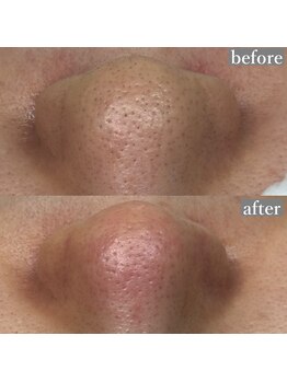 ライカブルー(RaicA BluE)/施術写真