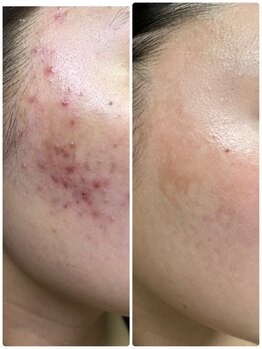 エステサロン 美飾り イオンモール木更津店/before⇒after/プラズマ