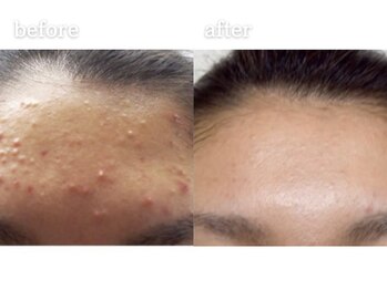 メルシア(merucia)/詰まり、ニキビケア、肌質改善