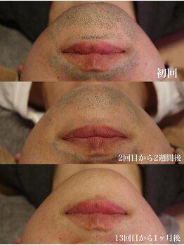 ベビースキン(baby skin)/髭脱毛