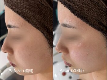 ウルト アルティメイトスキン(ULT ultimate skin)/ララピールで憧れの水光肌に!