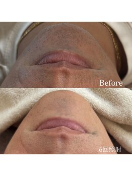 シュカ(Shuka)/髭脱毛