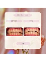 プラスビー 2号店(+b)/ホワイトニングビフォーアフター