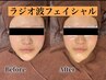 【小顔への近道◎】ほうれい線たるみ改善！¥6,500