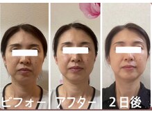 アクアナチュラ(ACQUANATURA)/たるみやほうれい線も！