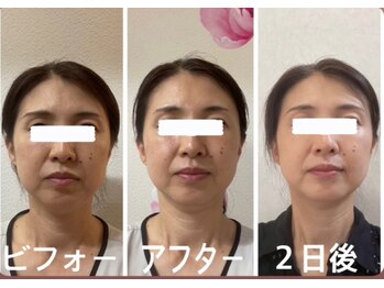 アクアナチュラ(ACQUANATURA)/たるみやほうれい線も!