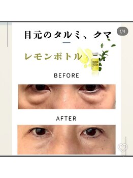 ロゼッティ(ROSETTY)/レモンボトル　目元のたるみクマ