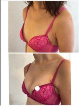 美人バスト 本厚木店/バストアップ◇症例◇