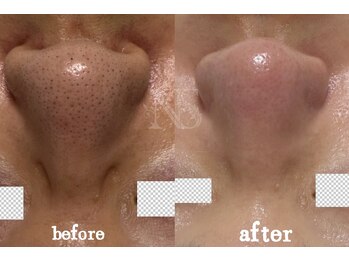 ナチュラ ソース(NatureSouce)の写真/人生変わる毛穴体験が人気!黒ずみケアをお得に試して満足の仕上がり♪