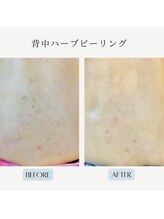 アロー(Allo!)/背中ハーブピーリング