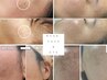＼人気No．１／プラズマで年齢問わずお肌のお悩み肌質改善×シミケア放題