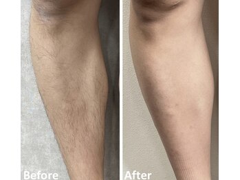 ベルフィオーレ(bel fiore)/メンズ脱毛 足