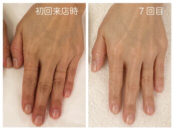 キレイテ 福岡天神店/50代/7回目【博多ハンドケア】