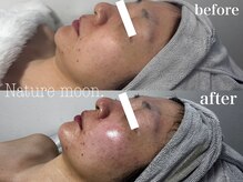 ナチュールムーン(Nature moon.)/ハーブピーリング