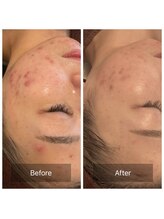 リバース(Rebirth)/ハーブの力で肌質改善