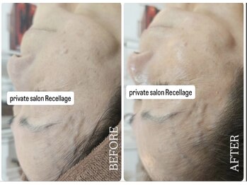 リセラージュ(Recellage)/グロッティプロ美肌フェイシャル