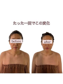 スカイ(sky)/頭蓋骨立体小顔矯正