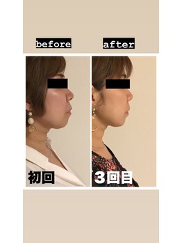 クラウドナインエステティック(Cloud Nine esthetic)/当サロンでリフトアップ!!